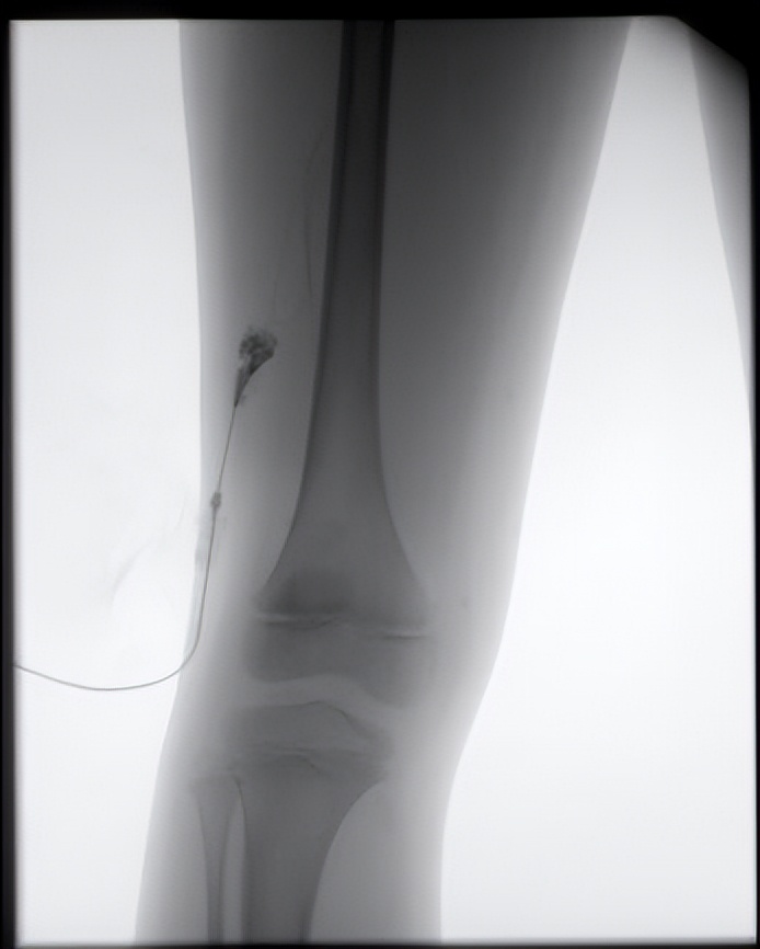 介入治疗淋巴管畸形的医学进展,淋巴管瘤有没有可能误诊