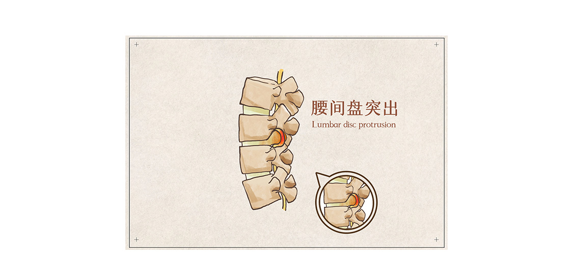 腰椎间盘突出注射干细胞,干细胞prp治疗腰椎间盘突出