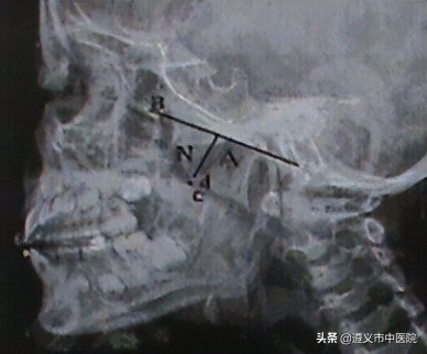 孩子打鼾该怎么办？