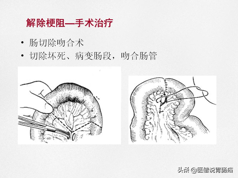 肠梗阻健康教育,肠梗阻患者的健康宣教