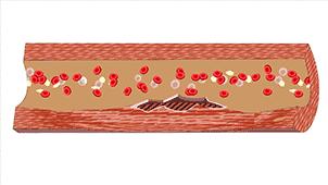 图解血管堵塞全过程，三氧疗法保持血管“年轻态”！
