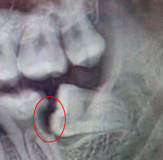 智齿是什么为什么人要长智齿,什么是智齿为什么会长智齿图片