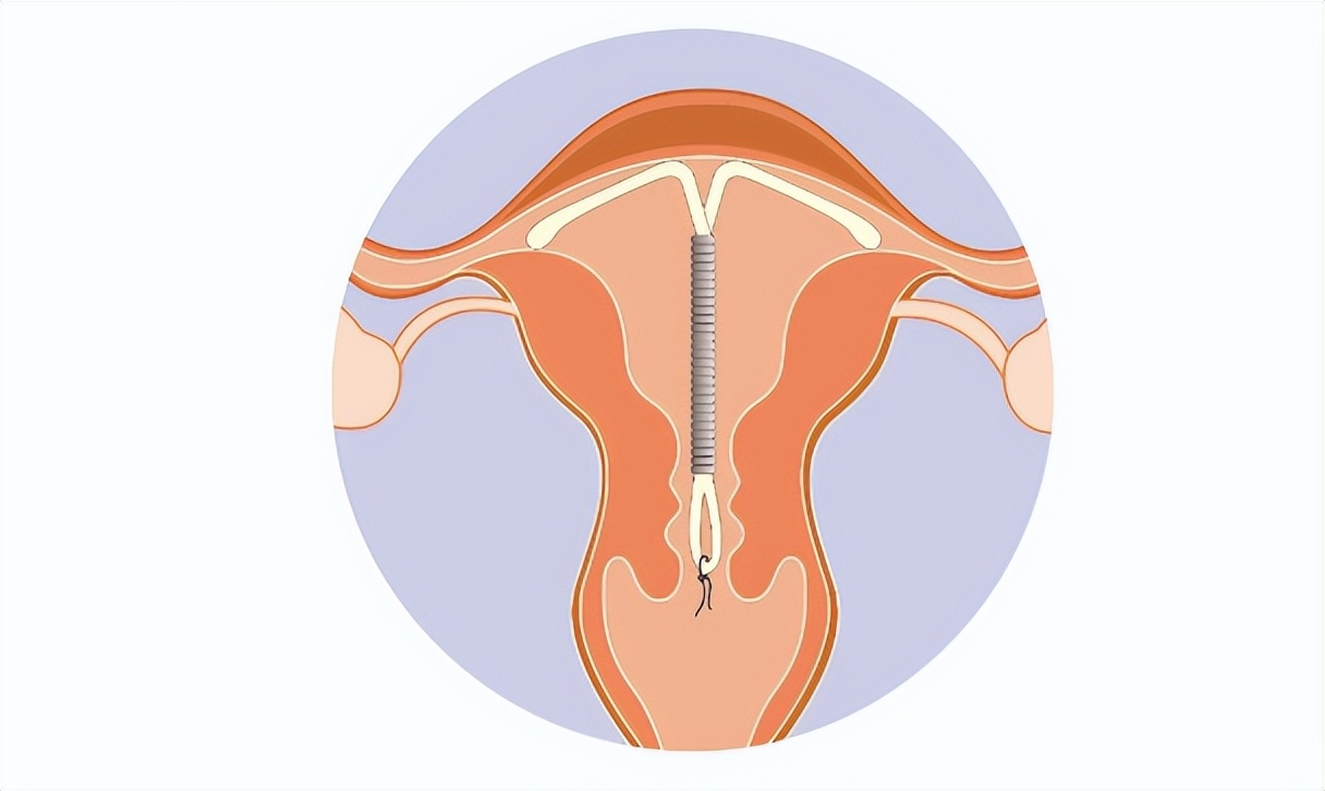 曼月乐环放了一年，为什么还有分泌物？