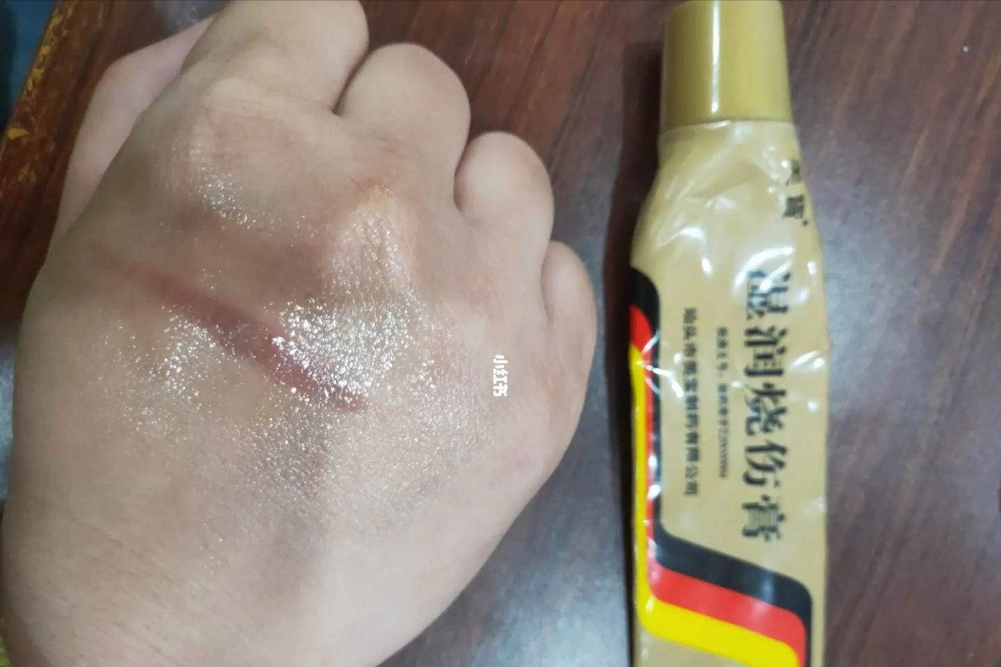 湿润烧伤膏对肛裂应用原理,湿润烧伤膏治疗肛周脓肿