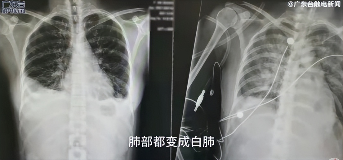 恙虫到底有多可怕？致死率极高