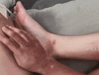 「网红玩具」爆炸！2岁孩子烧伤妈妈，快看看你家有吗？