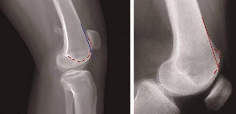 髌骨骨折评估,髌骨上下滑动评估什么内容