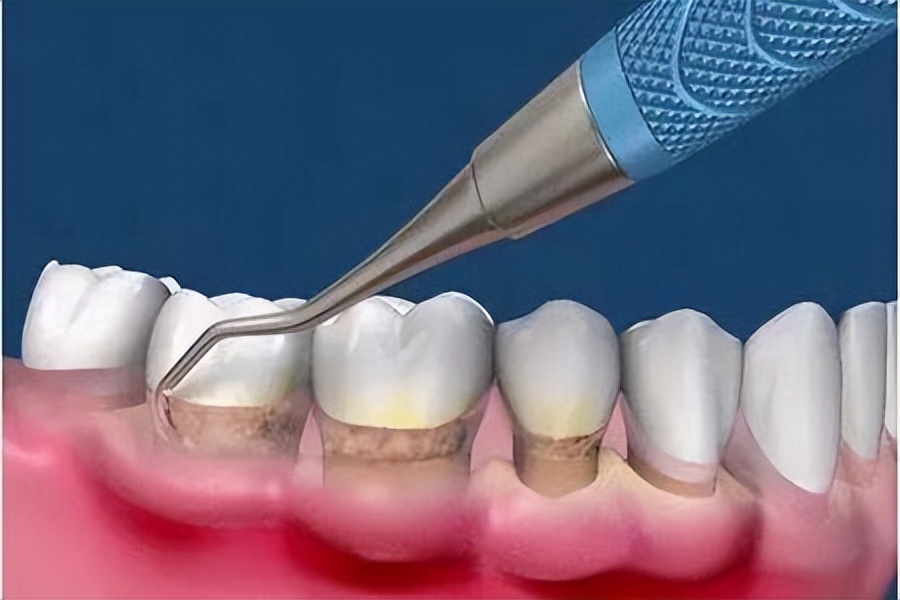 牙结石能直接抠下来吗,为什么牙结石可以用手抠出来