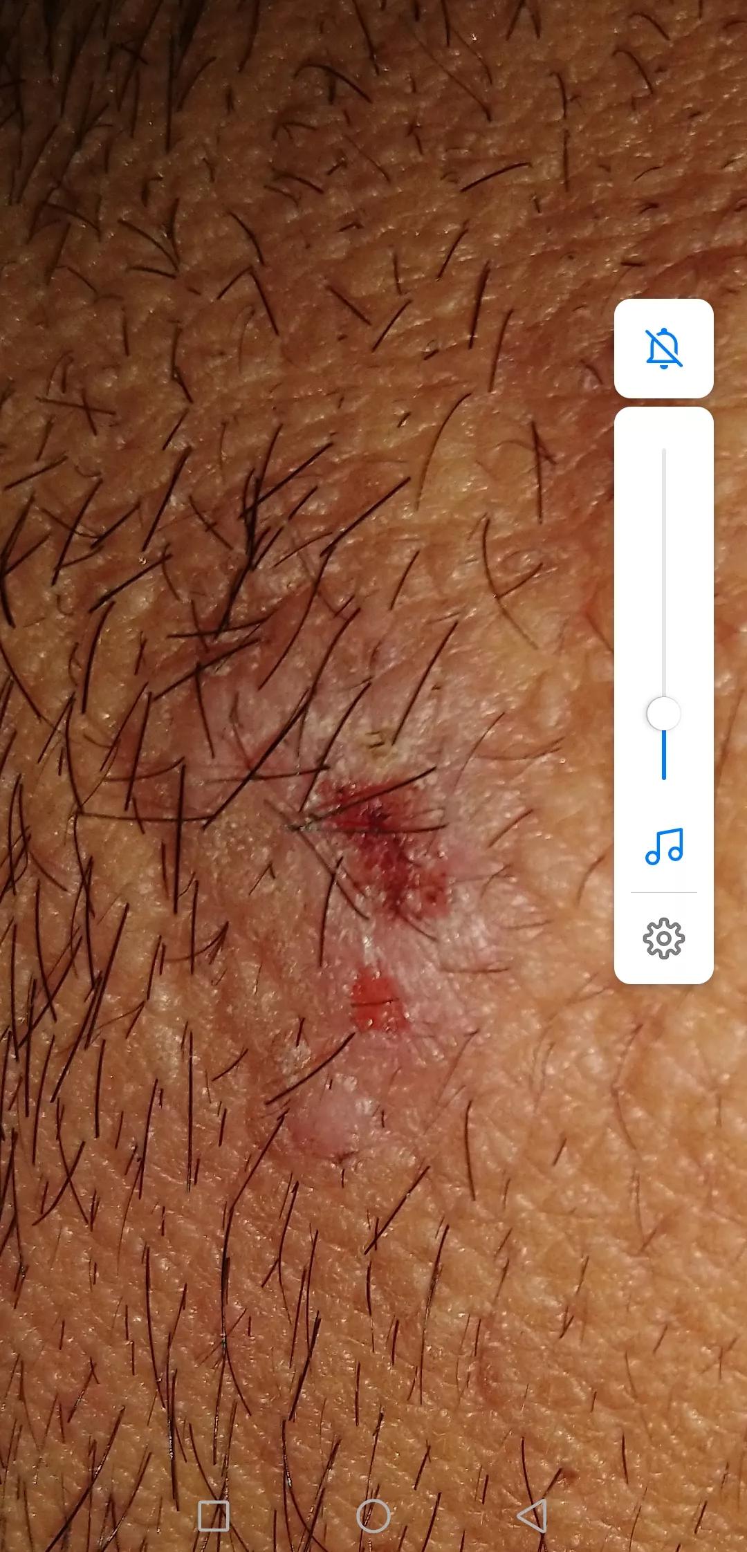 牛皮癣伴随一生是怎么样的体验,对抗牛皮癣一直在坚持