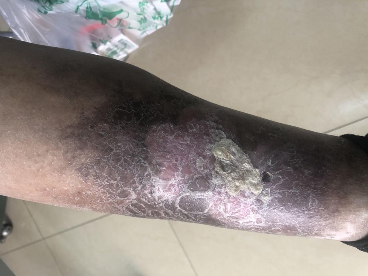 治愈老烂腿的方法,老烂腿怎么才能治愈