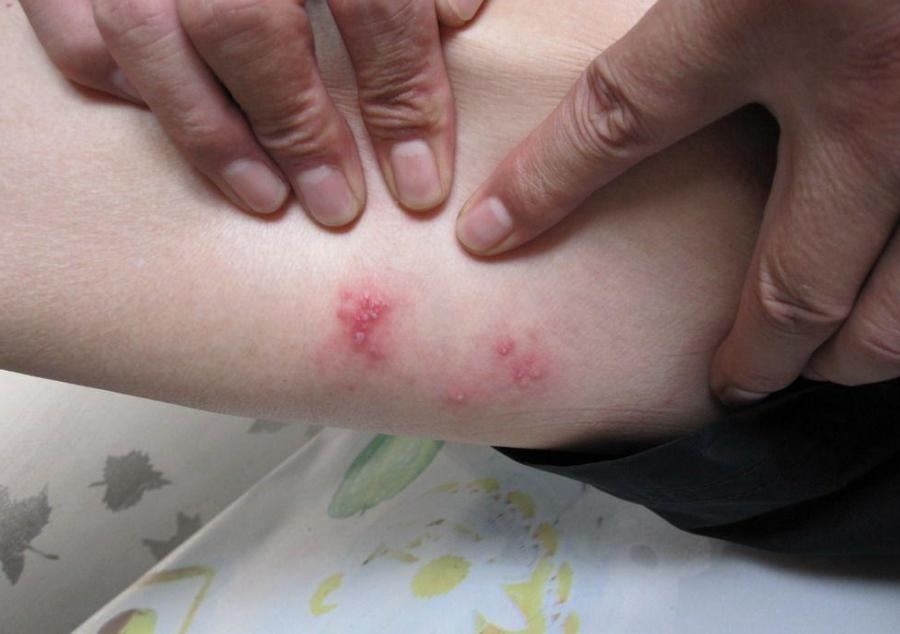 仓鼠咬人全身皮肤变成火龙果事件,杭州一女子买仓鼠得恙虫病