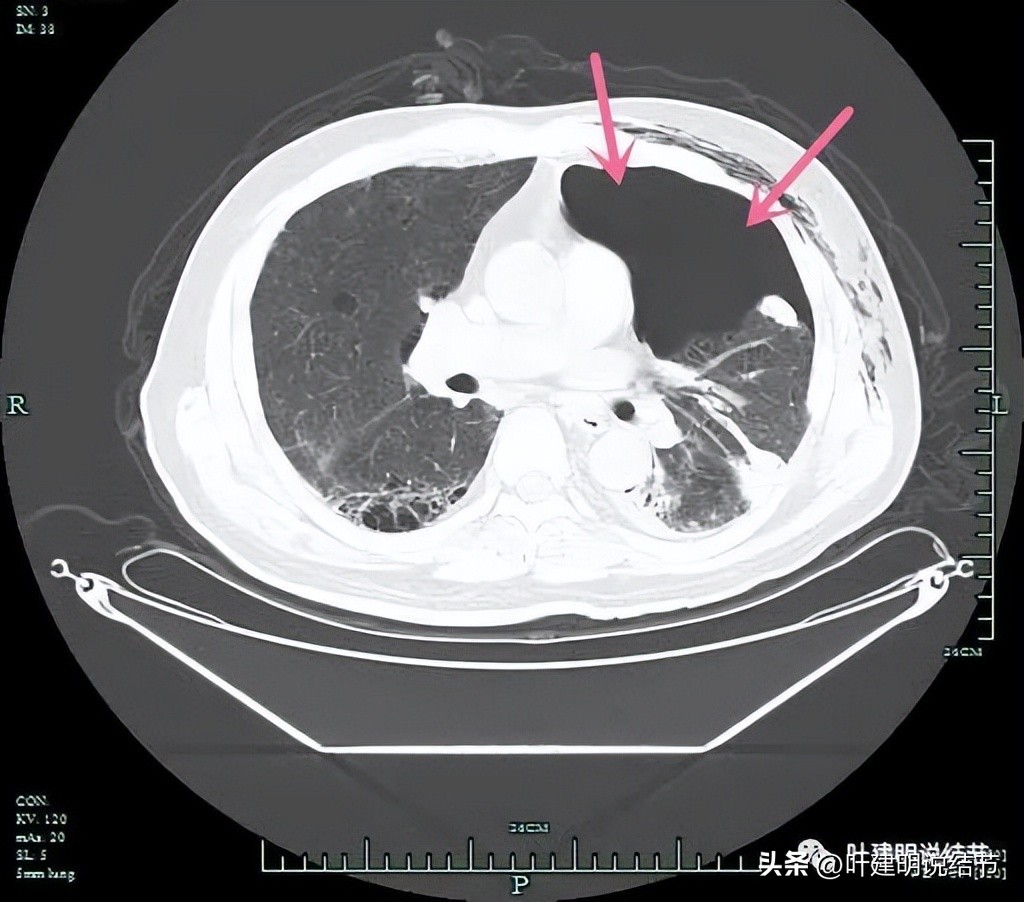 pet判断淋巴结转移,petct判断癌有没有转移准确吗