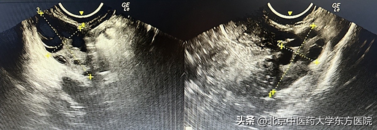 好消息！北京中医药大学东方医院多囊卵巢综合征专病门诊开诊啦！