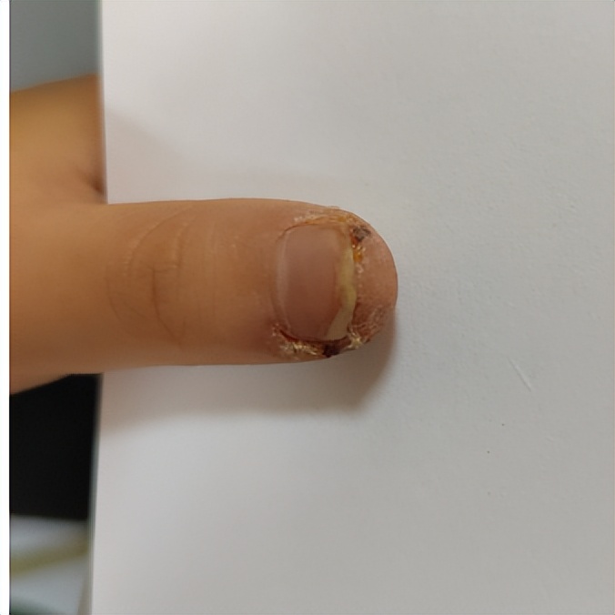 宝宝手指肿胀疼痛是怎么回事,小孩指头红肿疼痛是怎么了