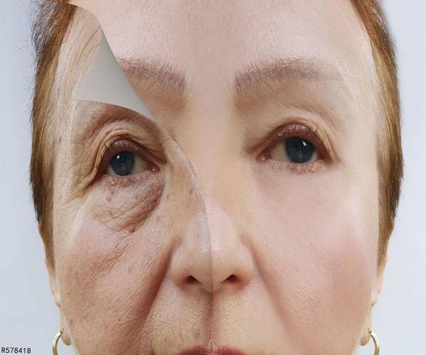 脸上老年斑有没有什么办法消除,脸上老年斑怎么消除最快方法