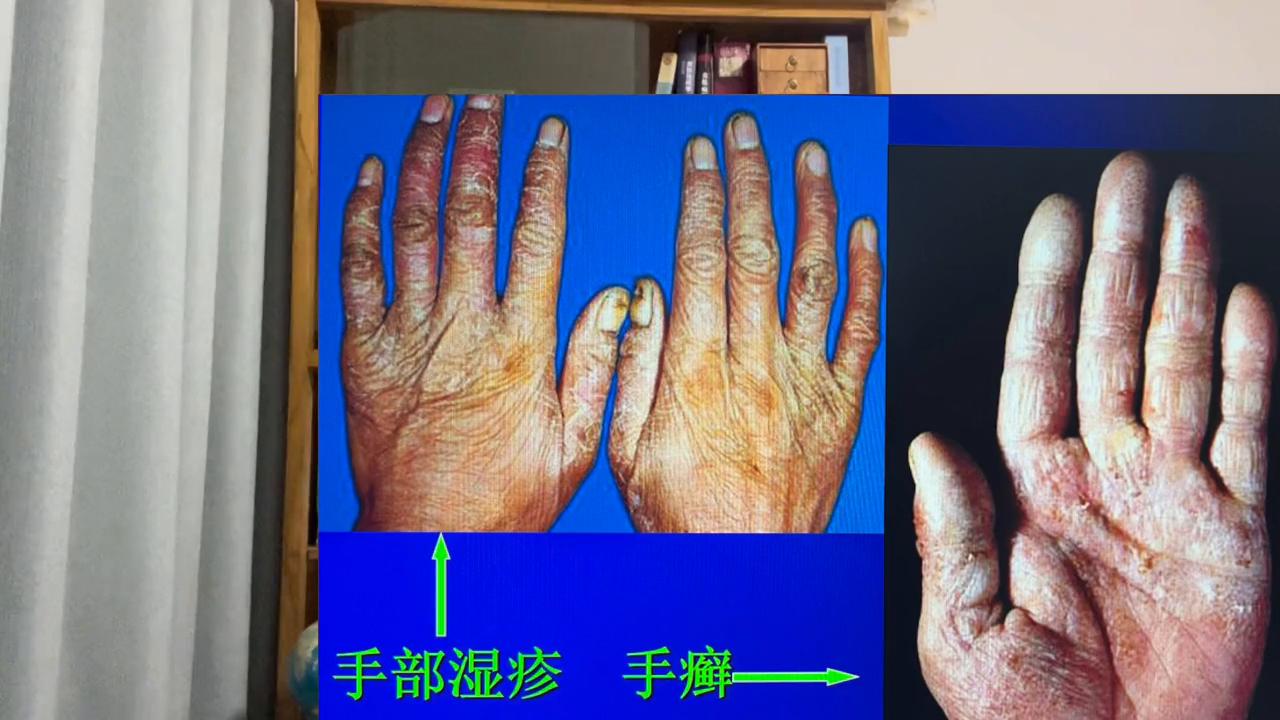 金钱癣和湿疹有什么区别,婴儿干性湿疹和癣的区别