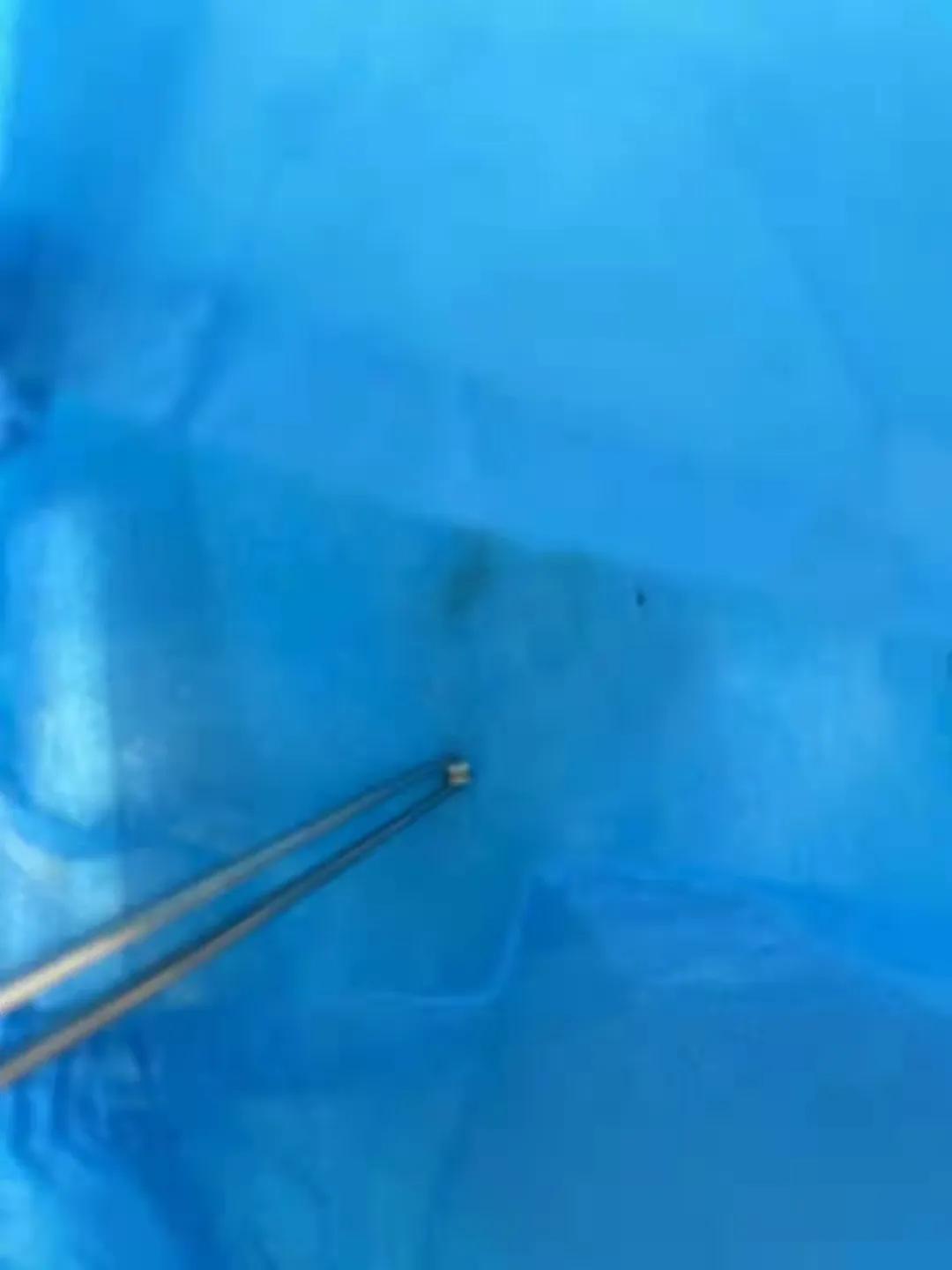 鼓膜置管半年了最近耳道有流血,鼓膜置管后流脓凝固