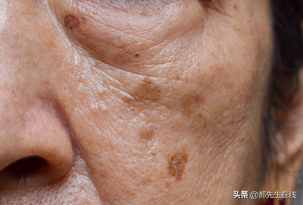 褐斑最好的消除方法,褐斑调理