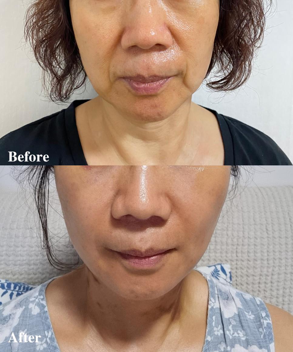 拉皮成功整容案例,拉皮提升面部手术对比图