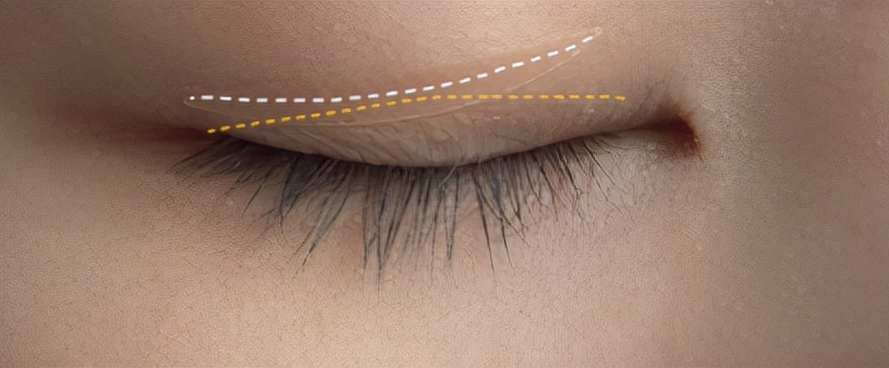 肿眼皮双眼皮贴正确的贴法,双眼皮贴干货