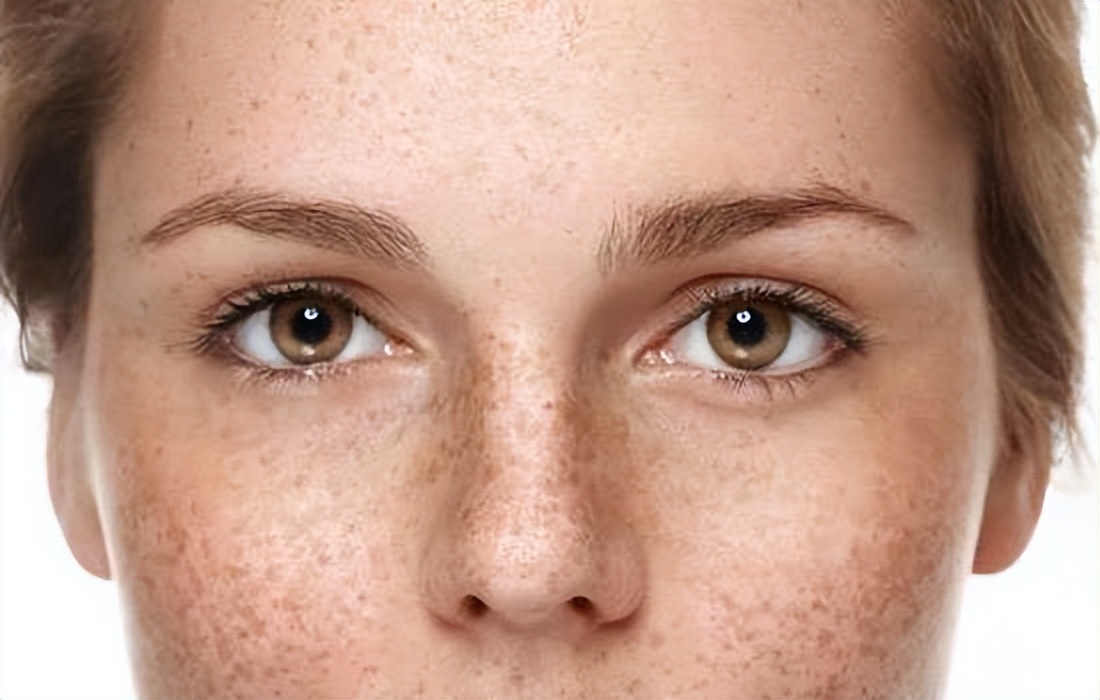 为什么有些人老年斑“密密麻麻”，有些人却没有？医生告诉你真相