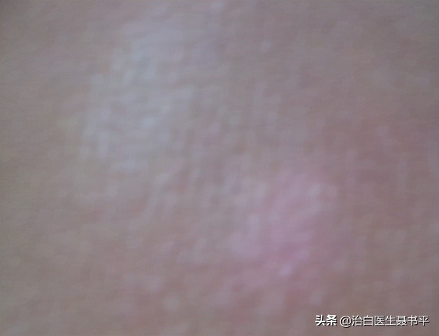 口腔粘膜白斑好转后粘膜变黑,白斑变黑能恢复