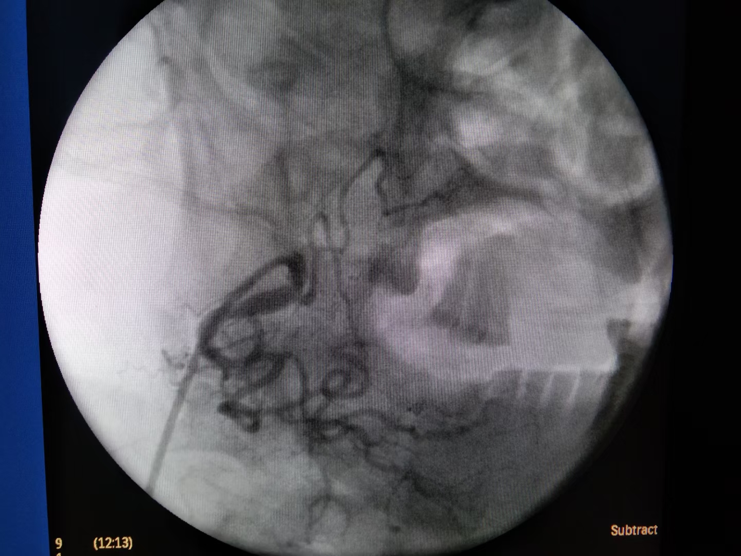 「病例分享」舌癌患者突发大出血，燥动不安，介入治疗成功止血