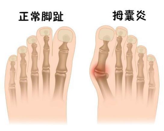 拇囊炎的原因和治疗方法,拇囊炎脚趾疼痛怎么缓解