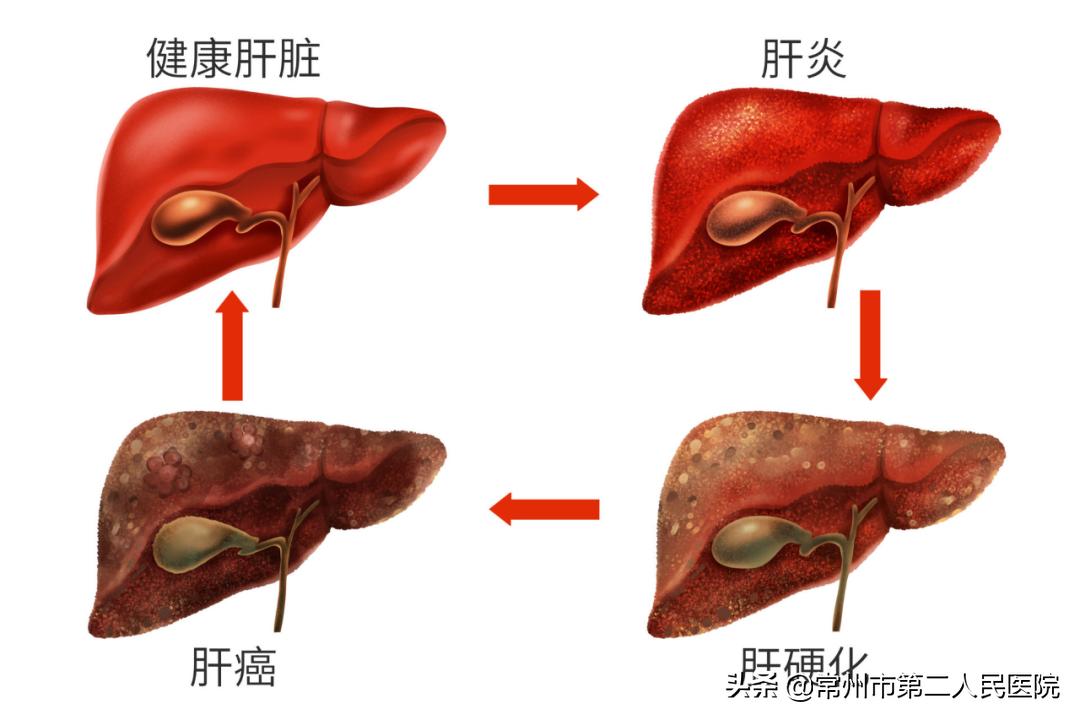 严重心脏病遇上肝肿瘤常州二院成功实施荧光腹腔镜下精准切除