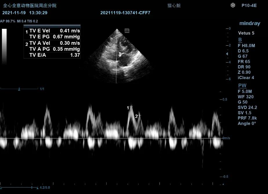 二尖瓣发育不良病例总结