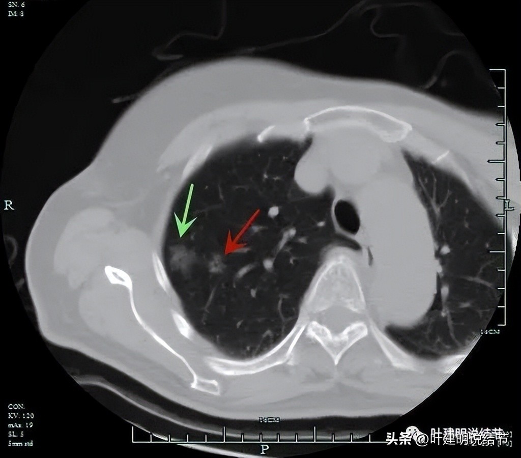 肺楔形切除肺功能降低,肺楔形切除需要缝合吗