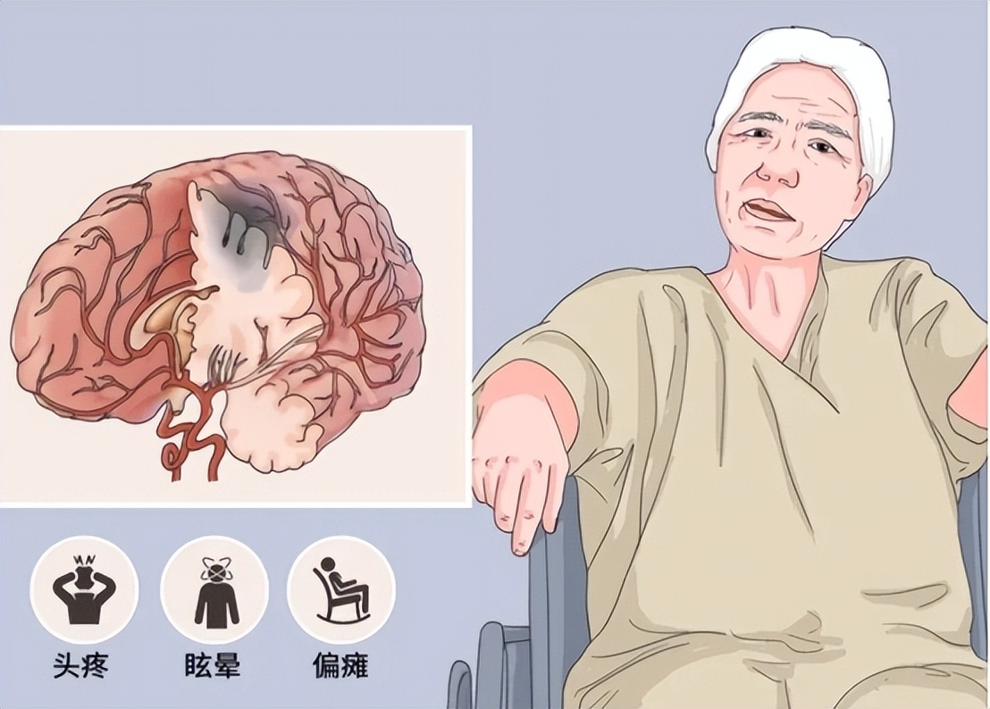 缺血性脑卒中中医治疗原则,急性缺血性脑卒中诊治指南最新版