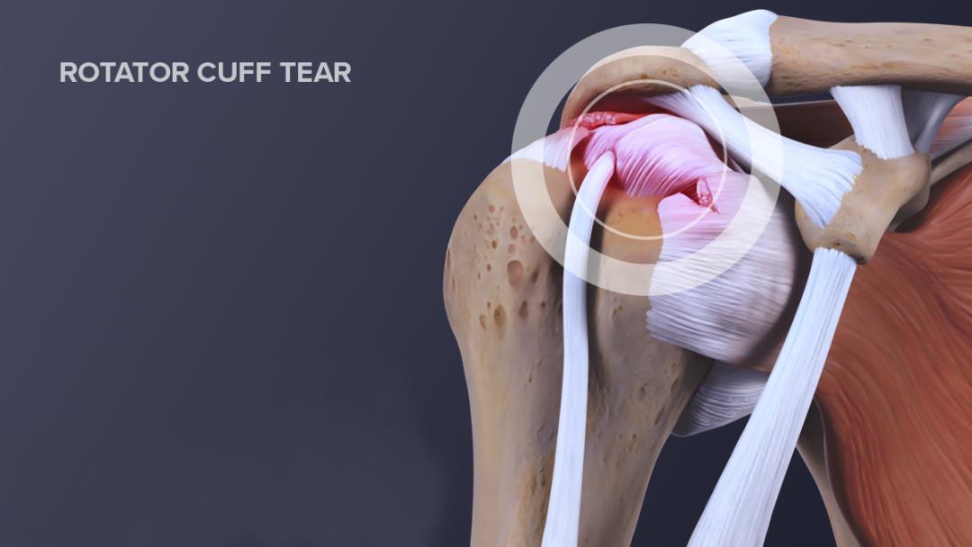 改善肩部疼痛的10个小练习