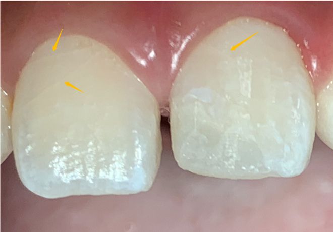 牙齿总是酸软无力是怎么回事,牙齿总是使不上劲怎么回事