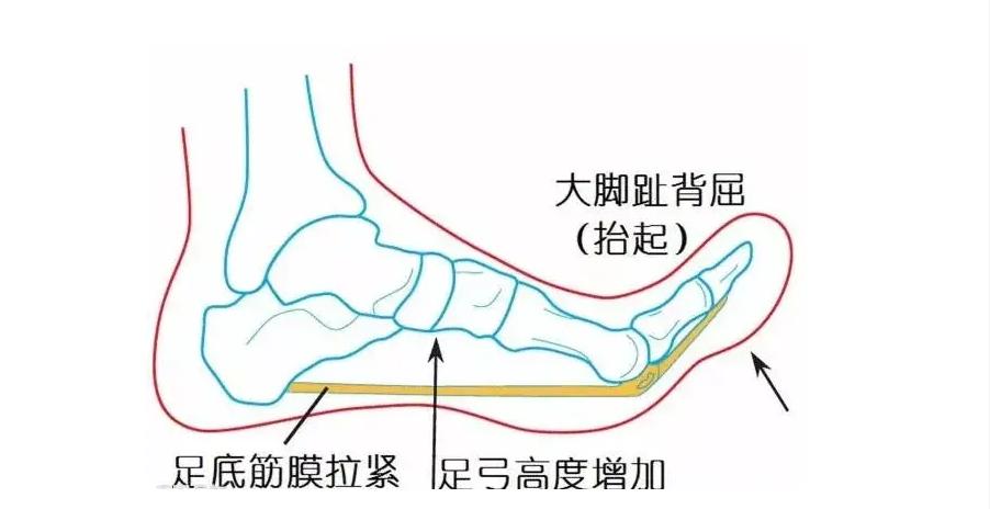 怎么缓解足底筋膜炎的疼痛,筋膜炎患者痛苦