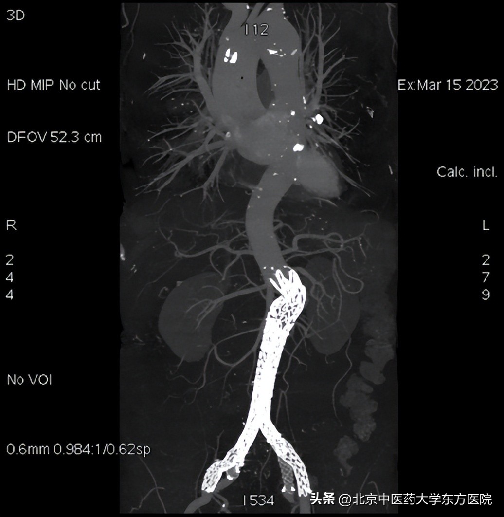 北京中医药大学东方医院成功完成首例保留双侧髂内动脉的巨大腹主动脉瘤合并双侧髂动脉瘤腔内隔绝术！