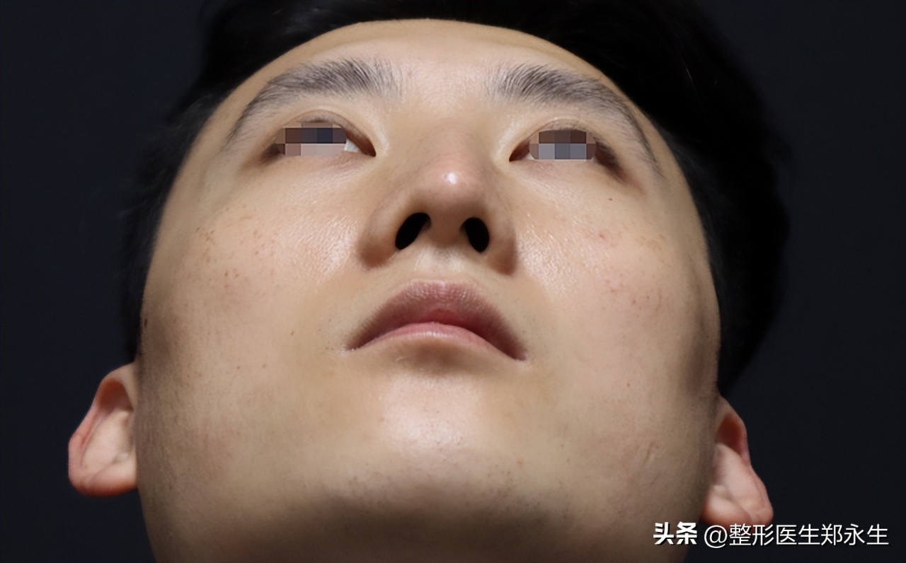 歪鼻子如何整形,歪鼻手术案例男
