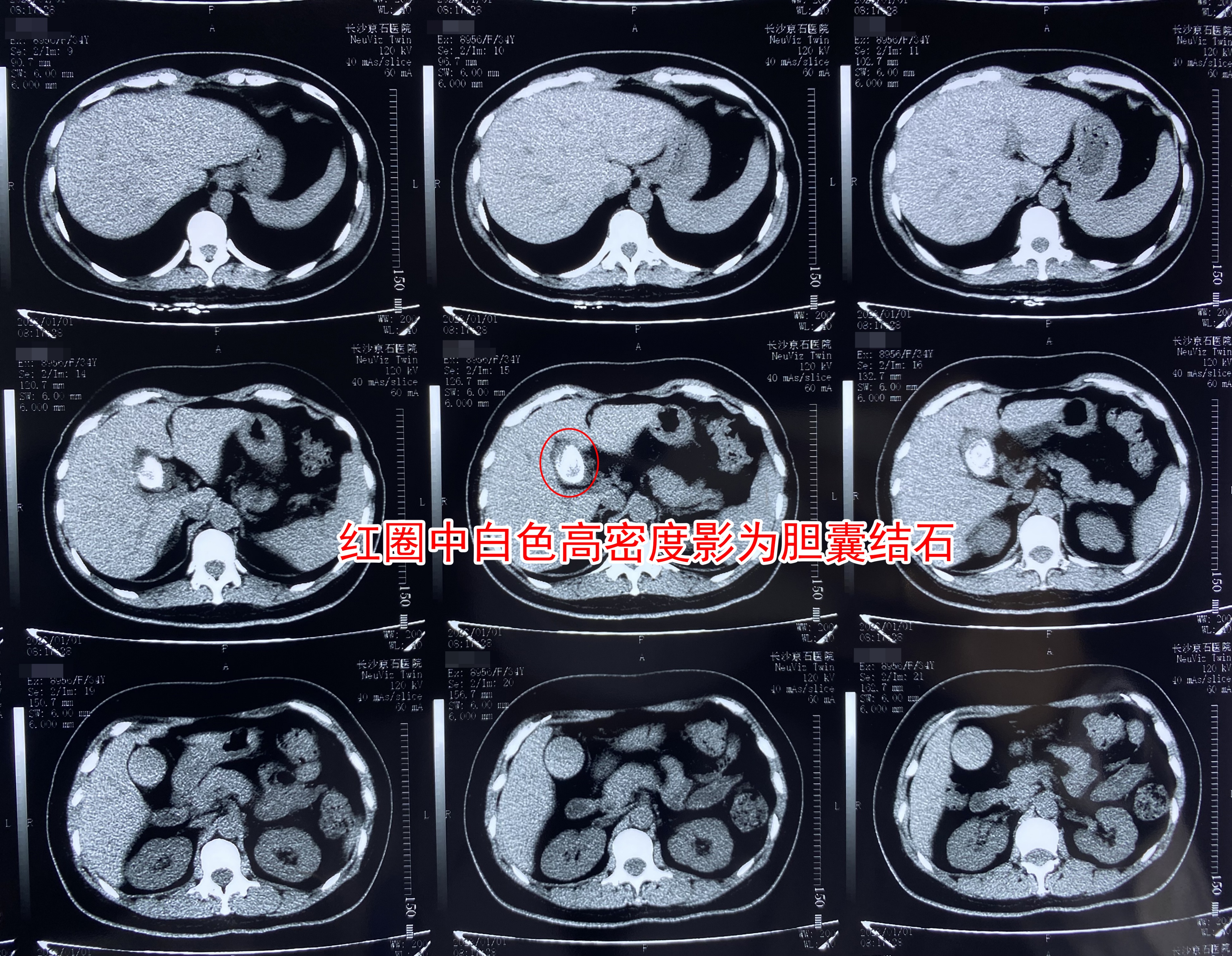 女子常年熬夜晚睡不吃早餐,女子长期不吃早饭得200多颗结石