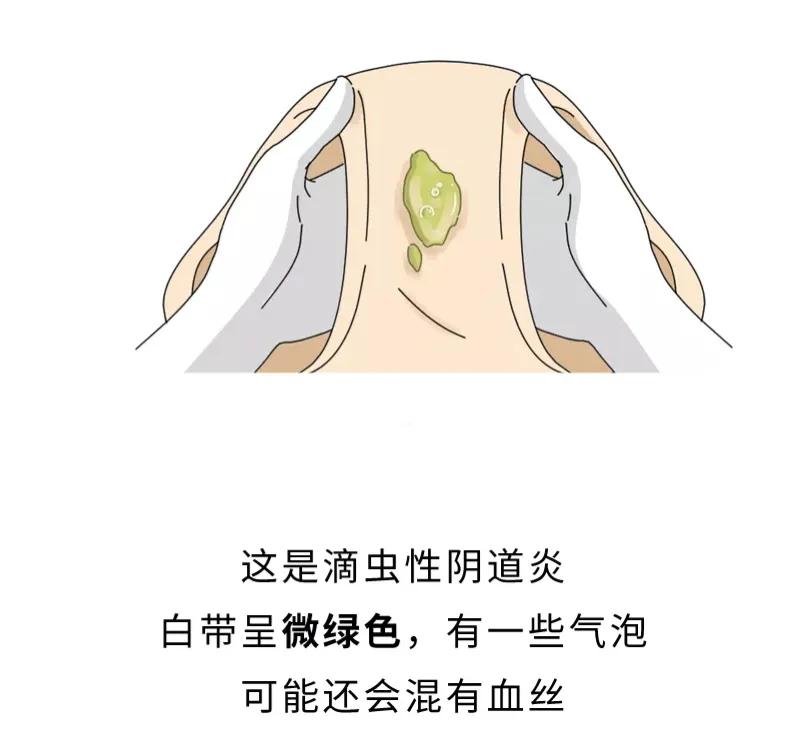 女生*处私**痒，居然是对“小蝌蚪”过敏？