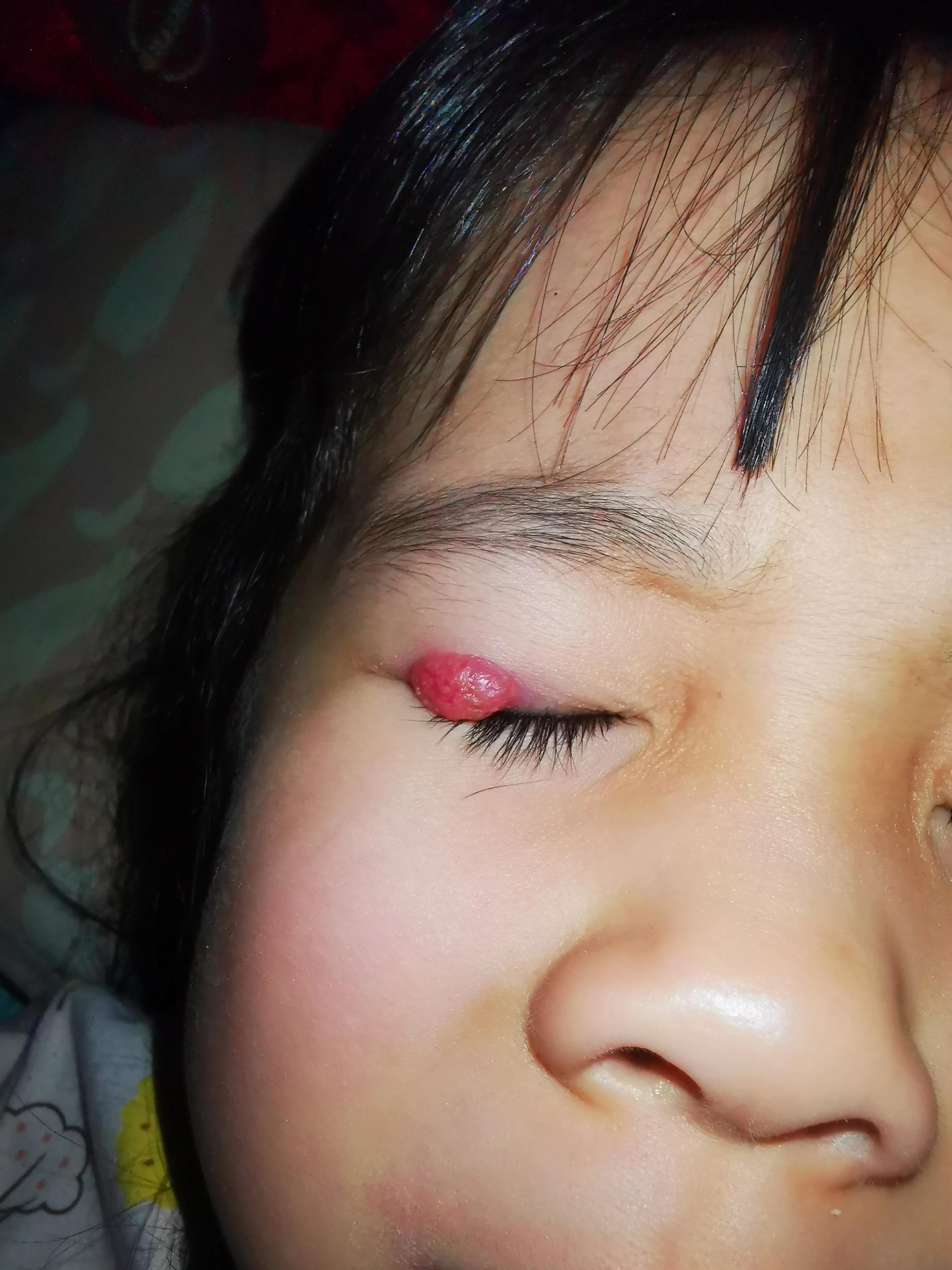 宝宝做霰粒肿手术有风险吗,霰粒肿手术会留疤痕吗