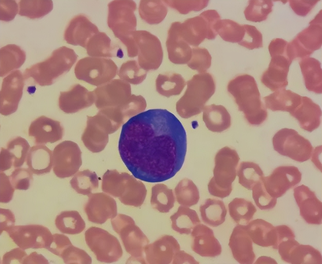 血常规指标高或低多少会有危险,血常规检查3项高有什么病