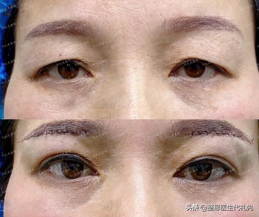 做提眉眼袋后需要用疤痕膏吗,提眉留疤痕了怎么办