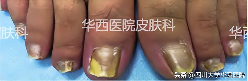 灰指甲到底算什么病,指甲黄是不是灰指甲