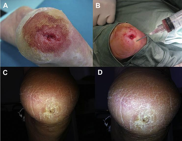 全球干细胞最新临床进展,干细胞再生医学现状