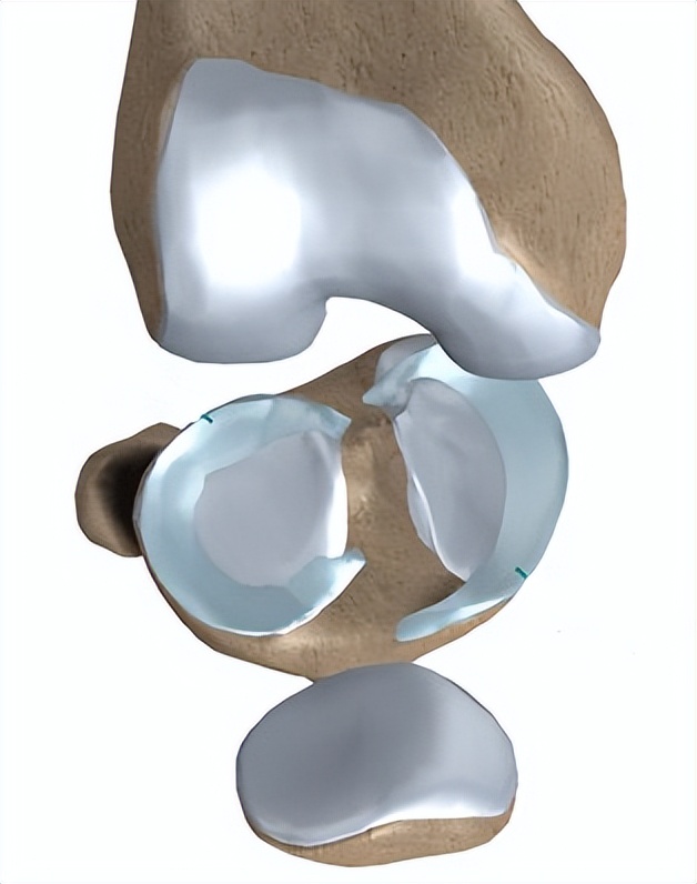 半月板撕裂如何治疗,半月板撕裂三度自愈成功的案例