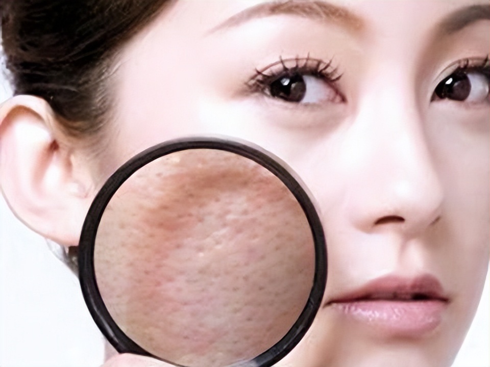 毛孔粗大有黑头怎么解决,毛孔粗大用医美怎么解决