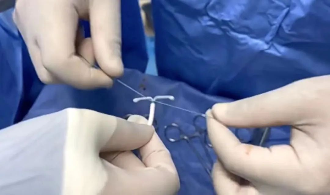 子宫腺肌症让子宫变大，“曼月乐”环也挂不住，咋办？