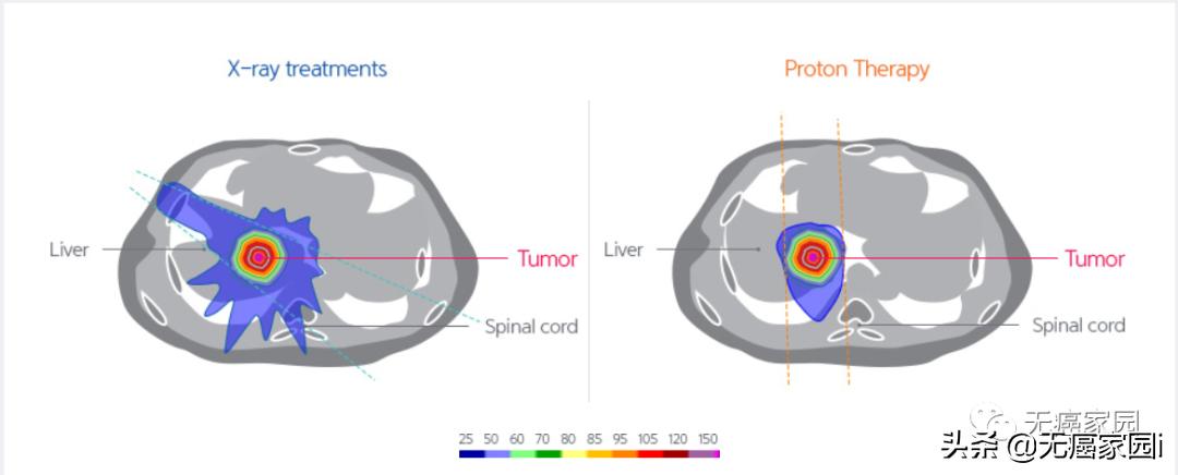 脑瘤、肺癌及儿童肿瘤等不妨考虑质子治疗,疗效和生存质量双保障