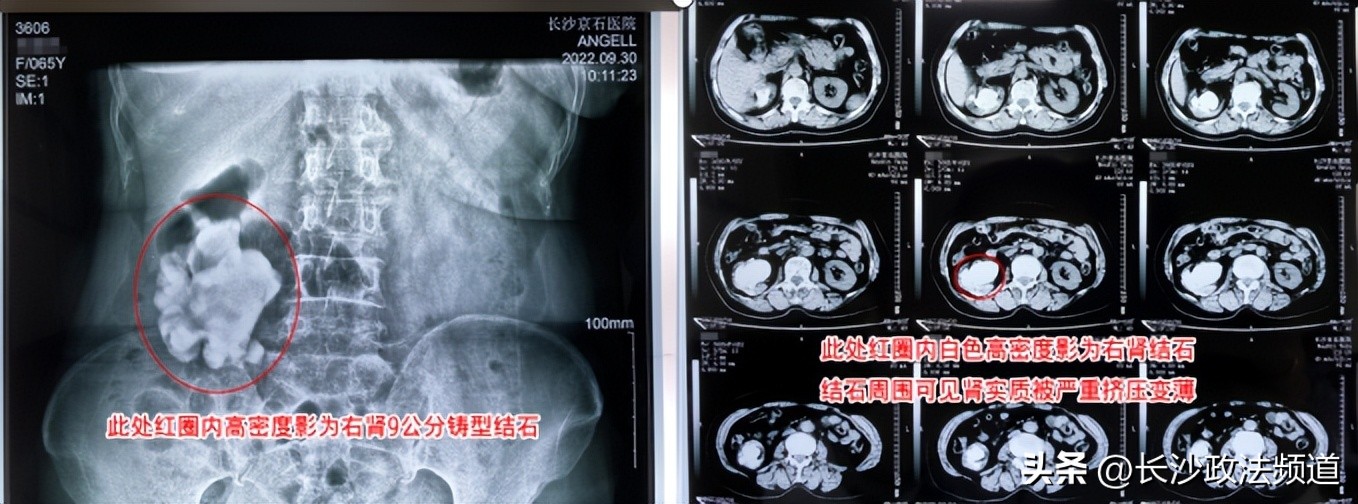 92岁高龄老人结石,83岁老奶奶胆囊结石1.5厘米