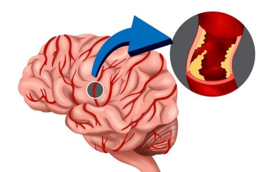 浅谈脑出血发病原因,脑出血好发于寒冷季节